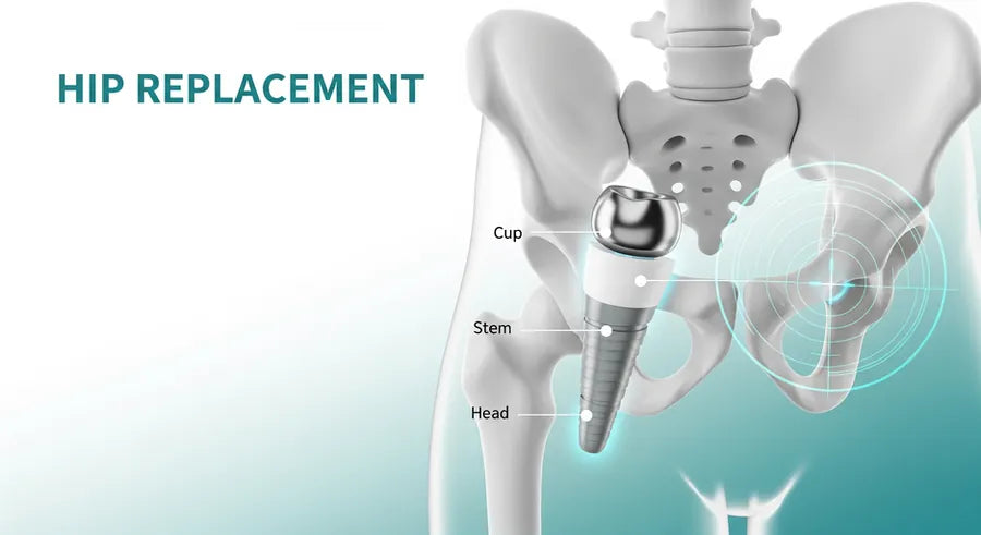 Total Hip Replacement