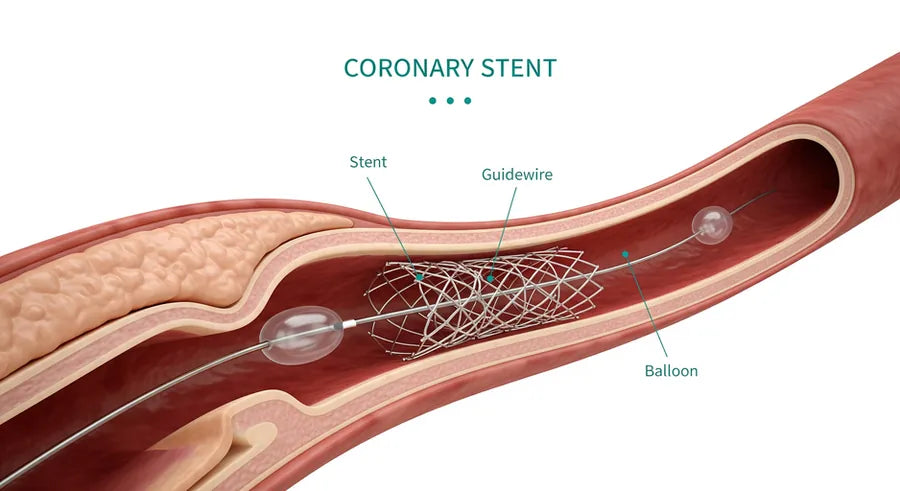 Percutaneous Coronary Intervention (PCI)